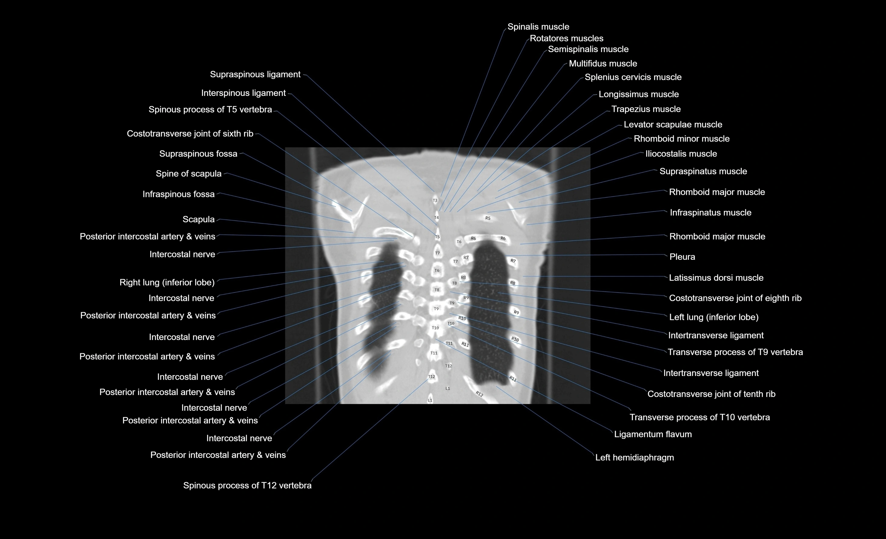 CT chest (thorax) lung window window labelled coronal cross sectional anatomy radiology image-00018.webp